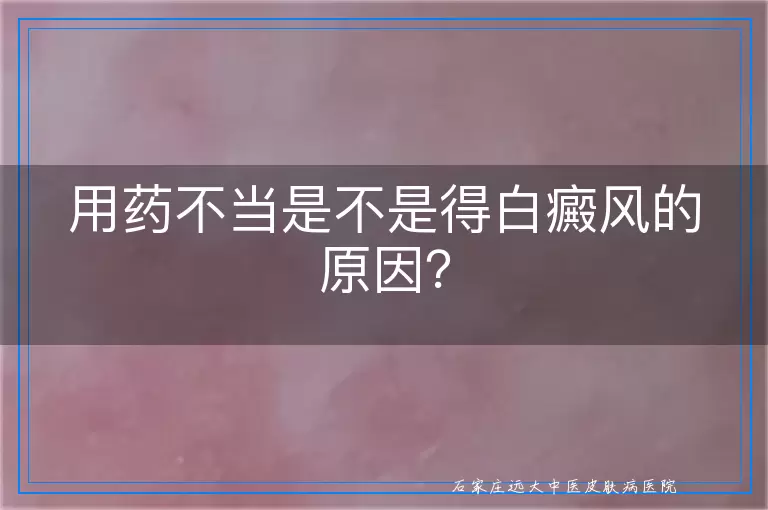 用药不当是不是得白癜风的原因？