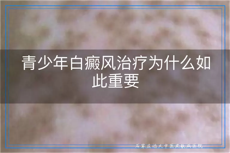 青少年白癜风治疗为什么如此重要
