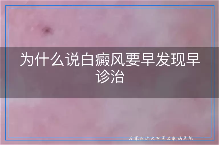 为什么说白癜风要早发现早诊治