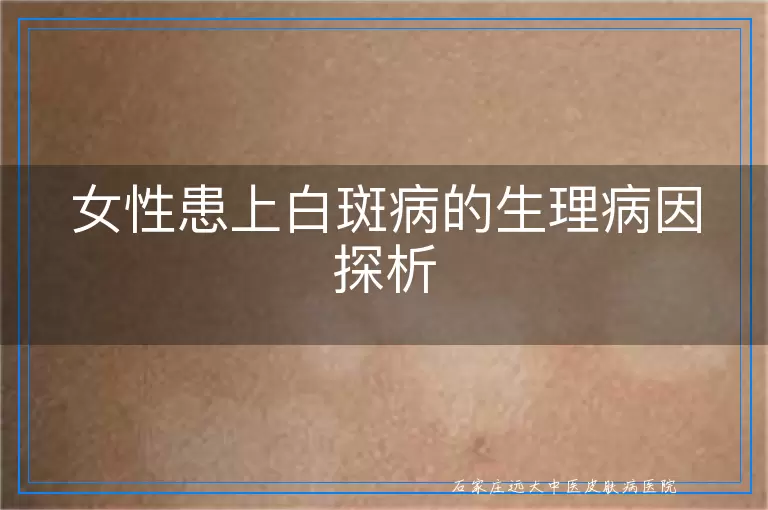 女性患上白斑病的生理病因探析