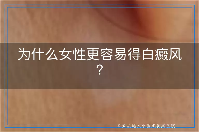 为什么女性更容易得白癜风？