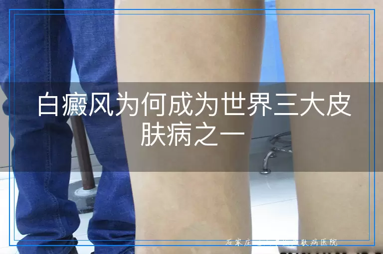 白癜风为何成为世界三大皮肤病之一