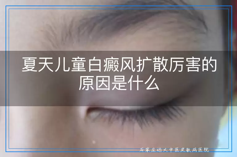 夏天儿童白癜风扩散厉害的原因是什么