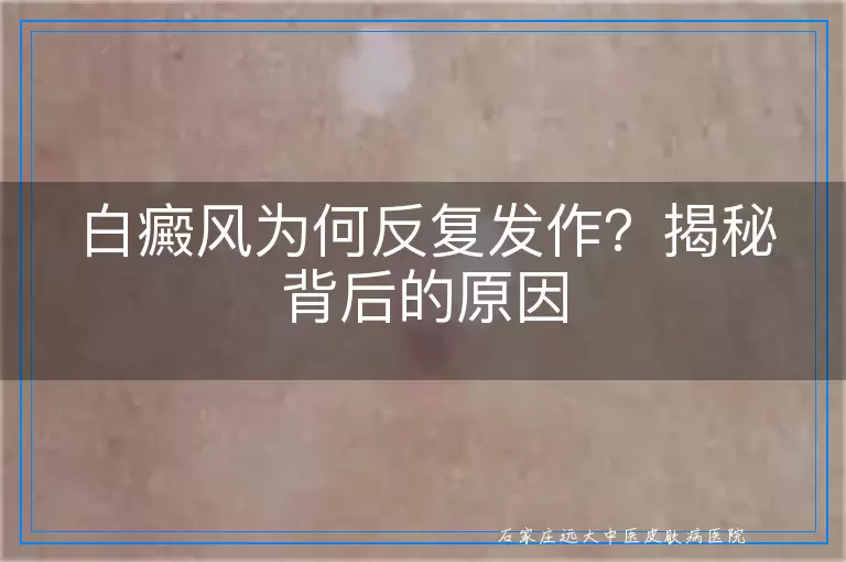 白癜风为何反复发作？揭秘背后的原因