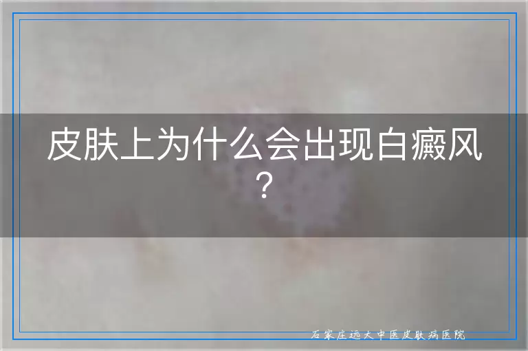 皮肤上为什么会出现白癜风？