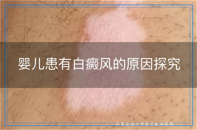 婴儿患有白癜风的原因探究