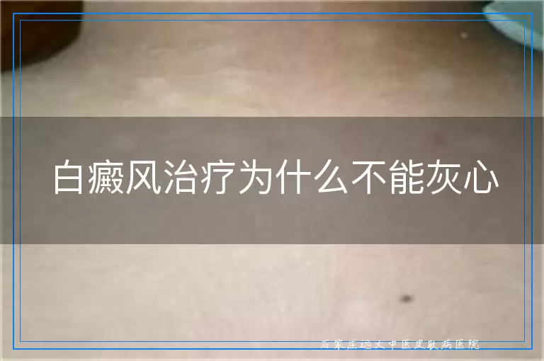 白癜风治疗为什么不能灰心