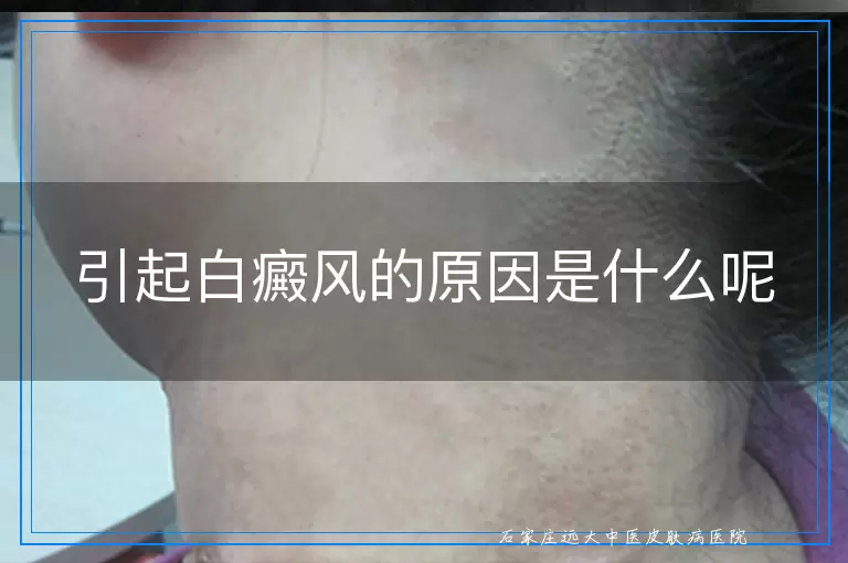 引起白癜风的原因是什么呢