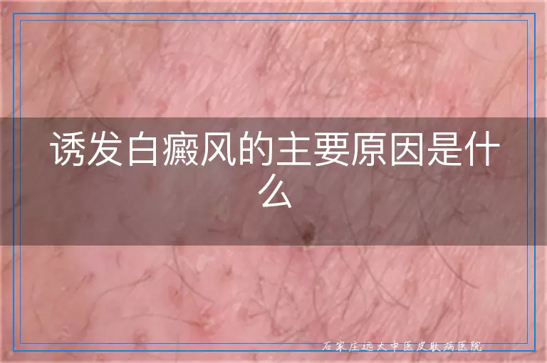 诱发白癜风的主要原因是什么