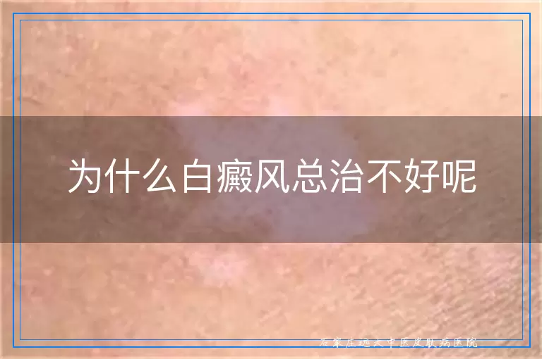 为什么白癜风总治不好呢