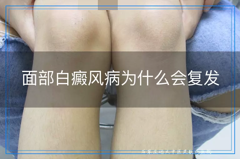 面部白癜风病为什么会复发