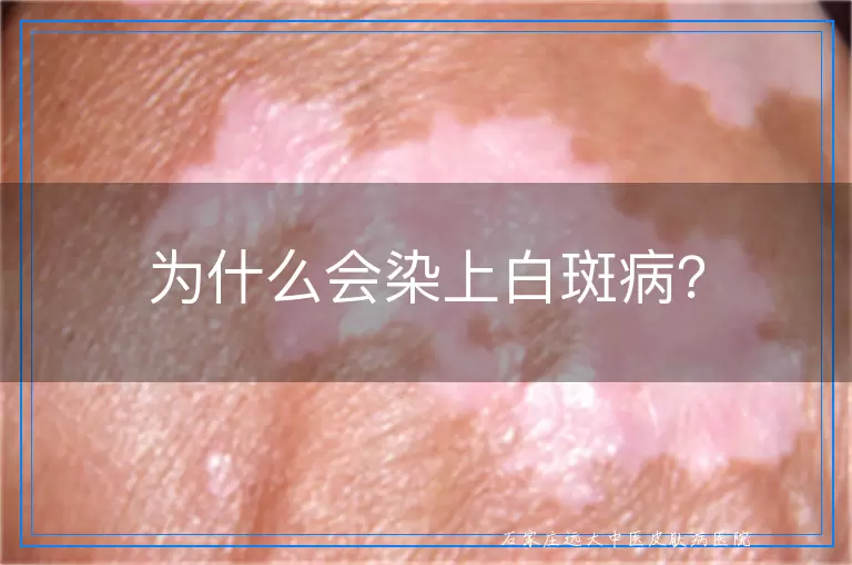 为什么会染上白斑病？