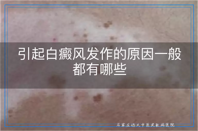 引起白癜风发作的原因一般都有哪些