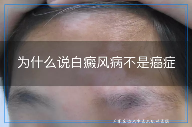 为什么说白癜风病不是癌症