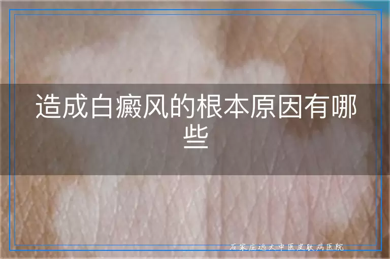 造成白癜风的根本原因有哪些
