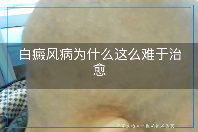 白癜风病为什么这么难于治愈