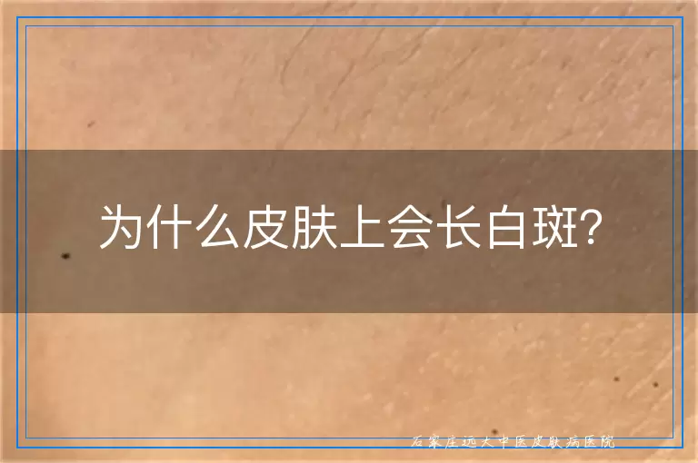 为什么皮肤上会长白斑？
