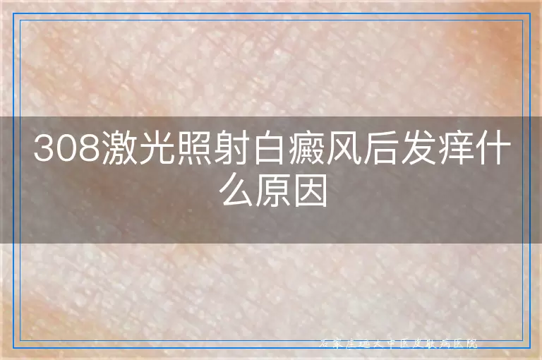 308激光照射白癜风后发痒什么原因
