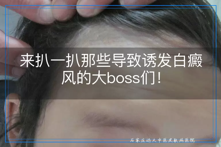来扒一扒那些导致诱发白癜风的大boss们！