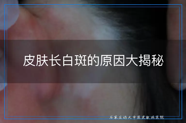 皮肤长白斑的原因大揭秘