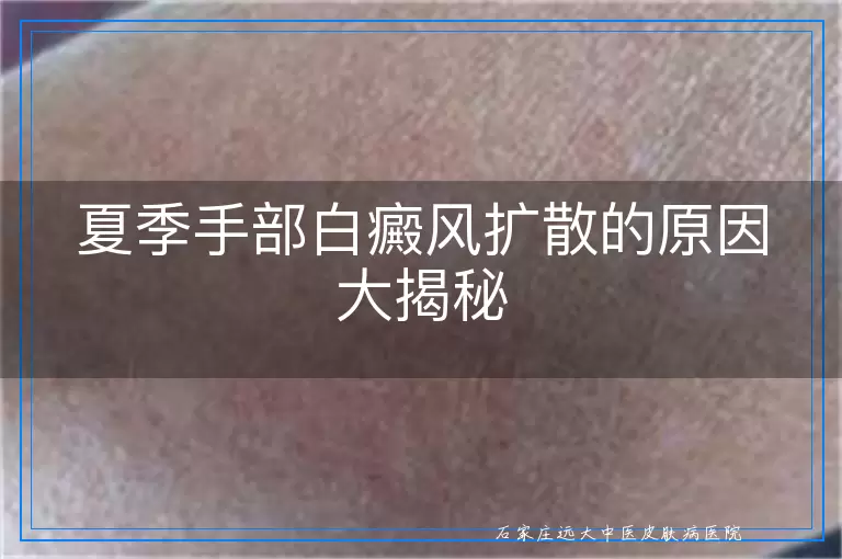 夏季手部白癜风扩散的原因大揭秘