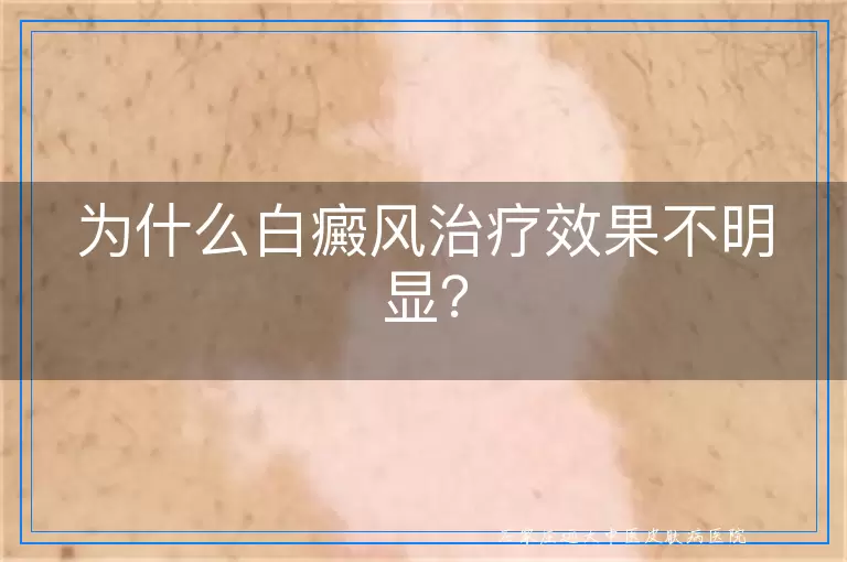 为什么白癜风治疗效果不明显？