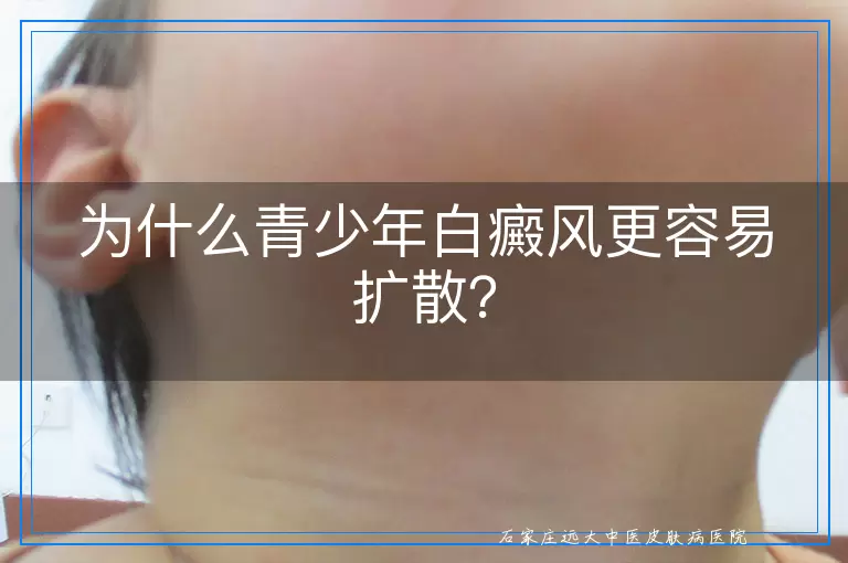 为什么青少年白癜风更容易扩散？