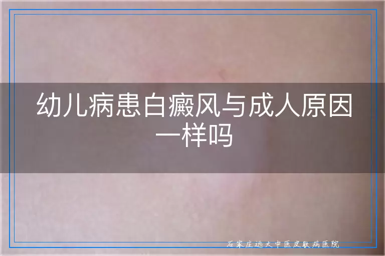 幼儿病患白癜风与成人原因一样吗