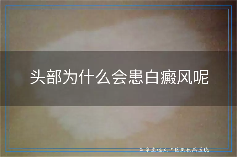头部为什么会患白癜风呢