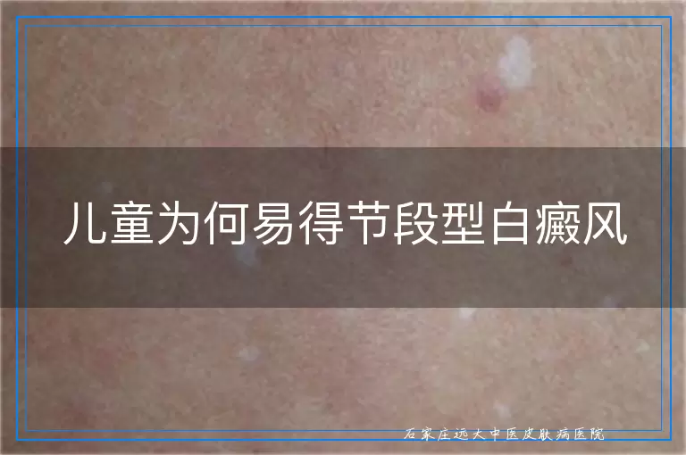 儿童为何易得节段型白癜风