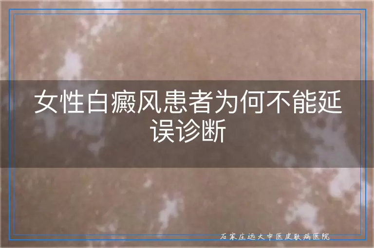 女性白癜风患者为何不能延误诊断