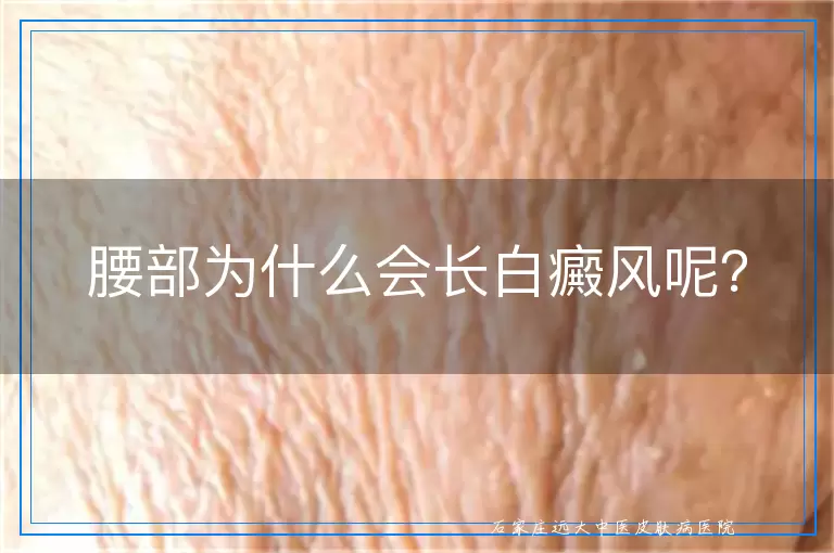腰部为什么会长白癜风呢？