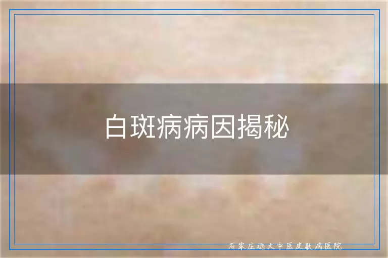 白斑病病因揭秘