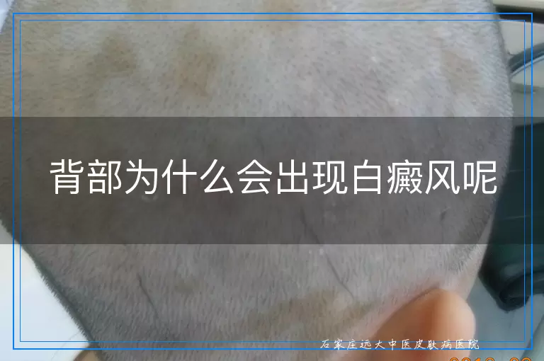 背部为什么会出现白癜风呢