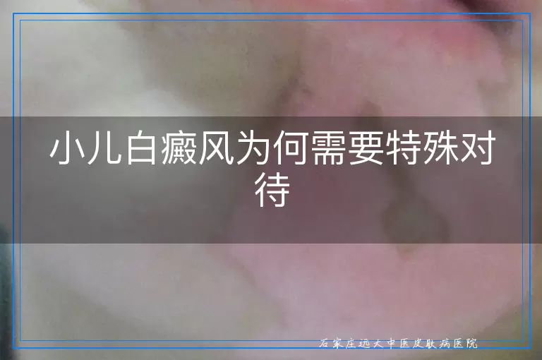 小儿白癜风为何需要特殊对待