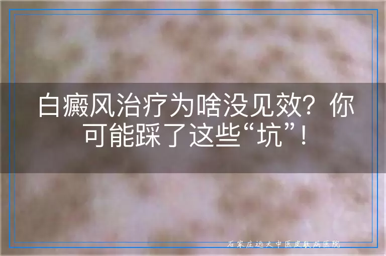 白癜风治疗为啥没见效？你可能踩了这些“坑”！