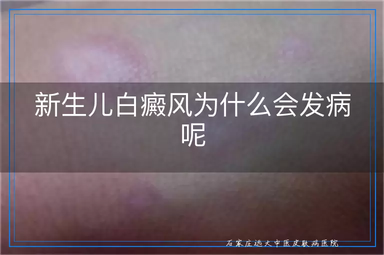 新生儿白癜风为什么会发病呢