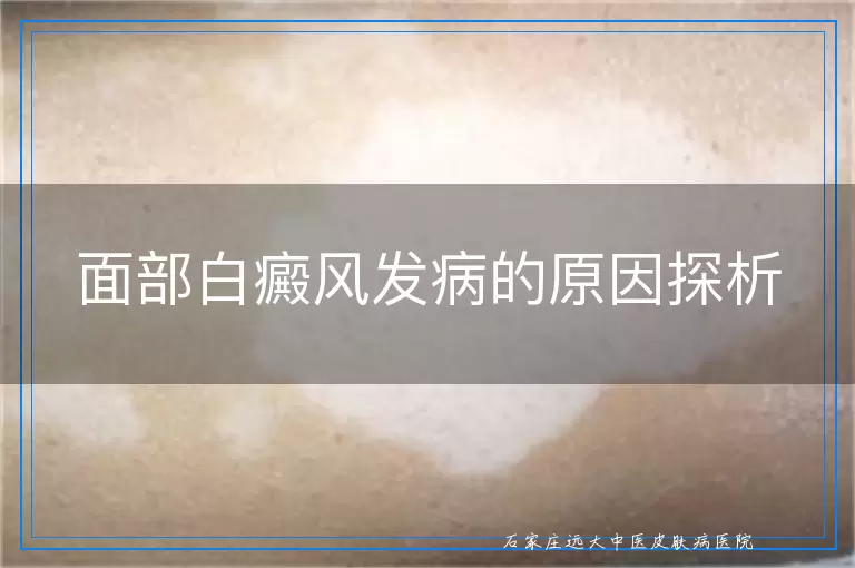 面部白癜风发病的原因探析