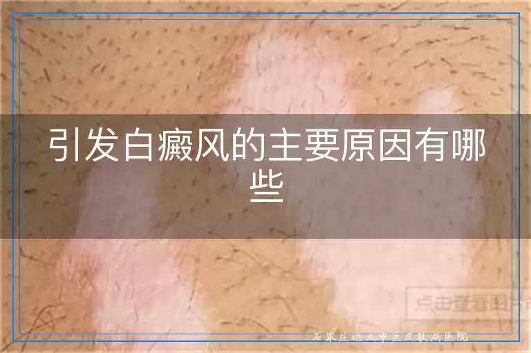 引发白癜风的主要原因有哪些