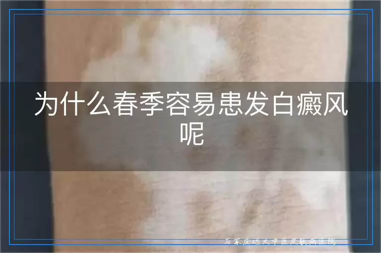 为什么春季容易患发白癜风呢