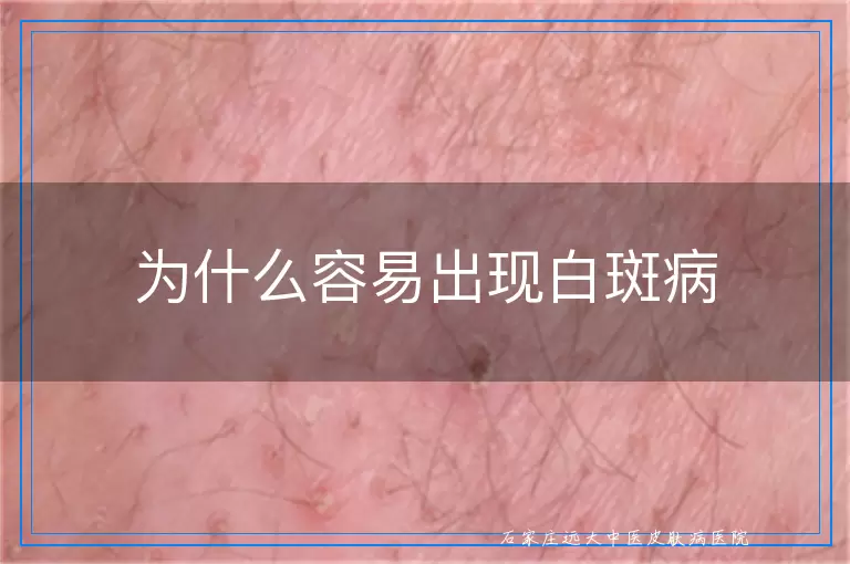 为什么容易出现白斑病