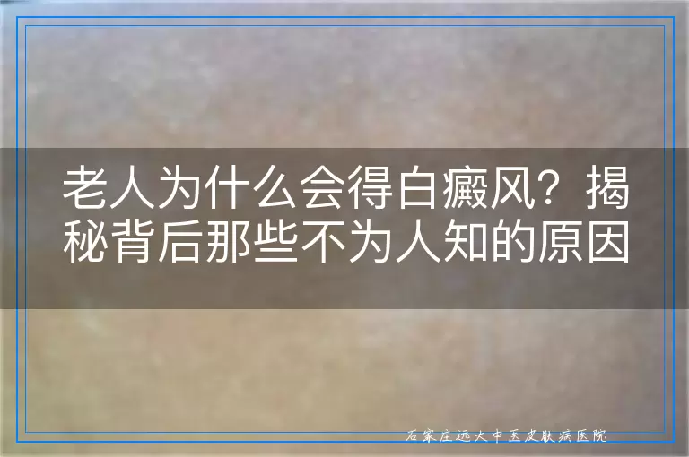 老人为什么会得白癜风？揭秘背后那些不为人知的原因