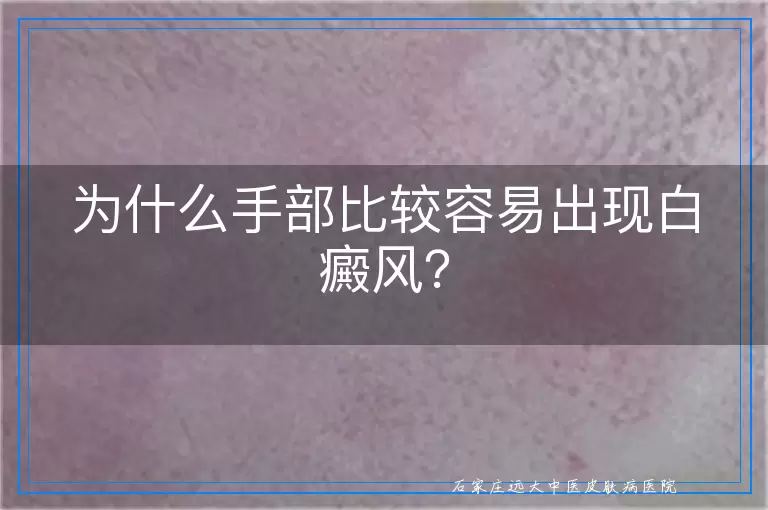 为什么手部比较容易出现白癜风？
