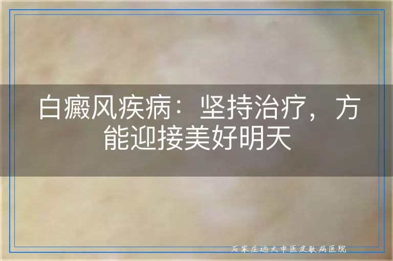 白癜风疾病：坚持治疗，方能迎接美好明天