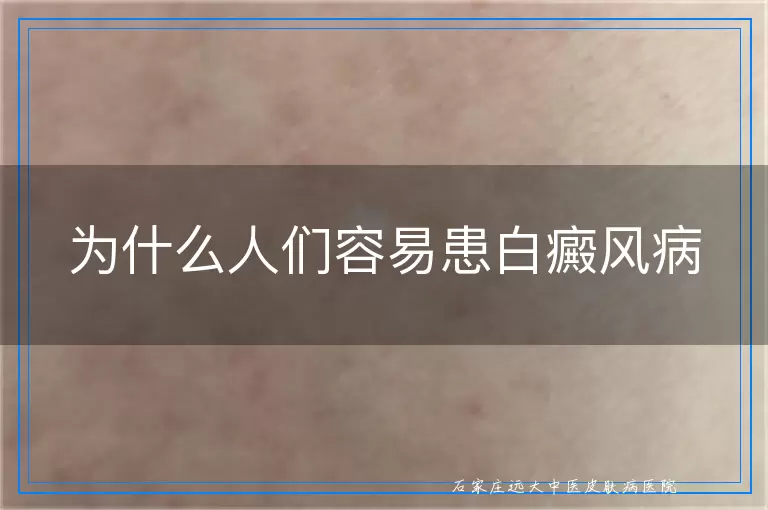 为什么人们容易患白癜风病