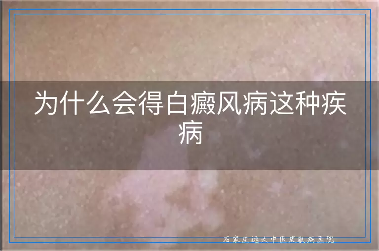 为什么会得白癜风病这种疾病