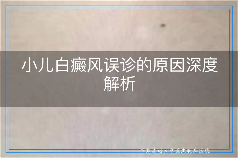 小儿白癜风误诊的原因深度解析