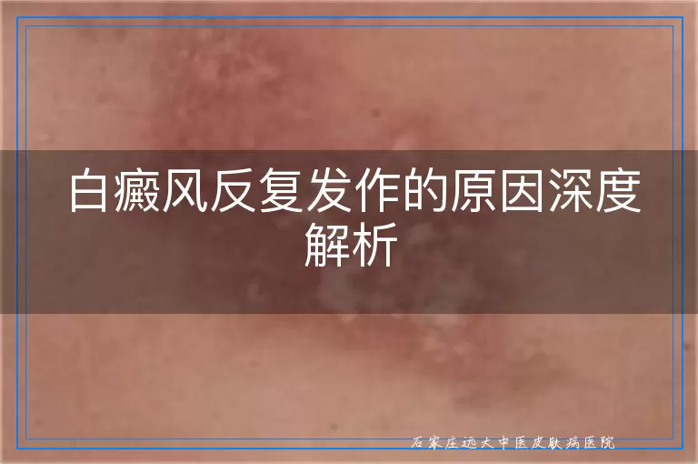 白癜风反复发作的原因深度解析