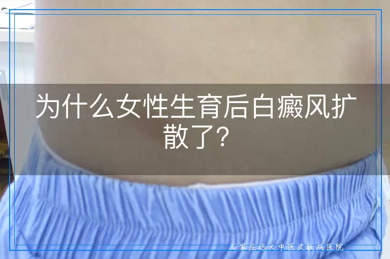为什么女性生育后白癜风扩散了？