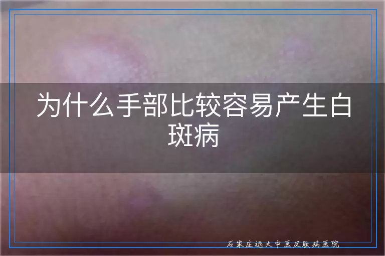 为什么手部比较容易产生白斑病